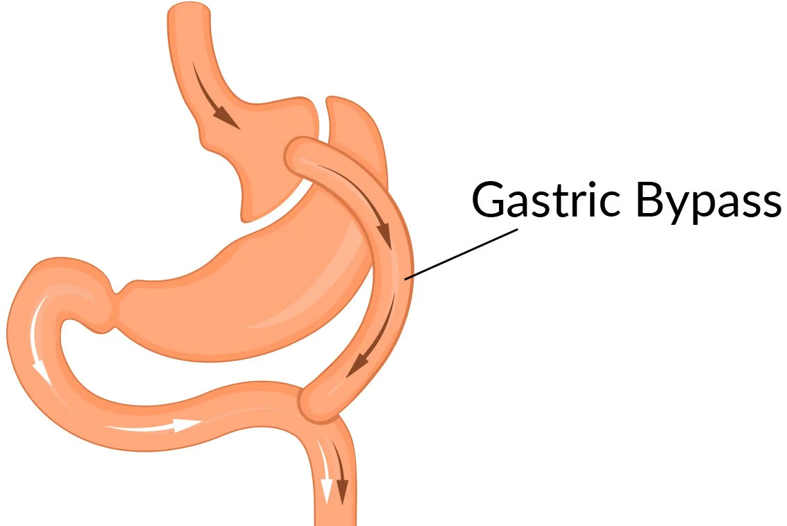 Gastric Bypass Recovery: A Road to a Healthier You