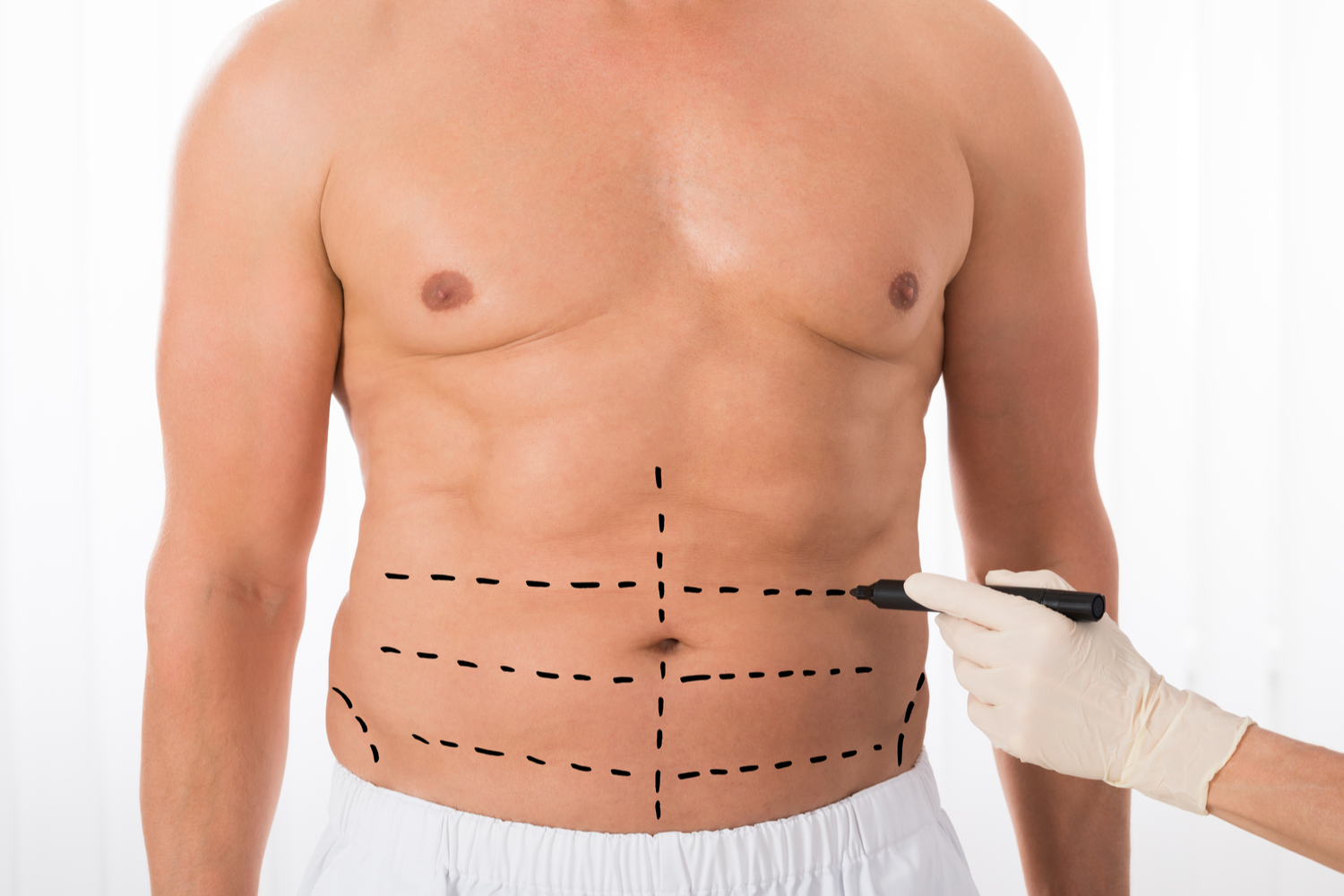 Liposuction for Men: A Growing Trend