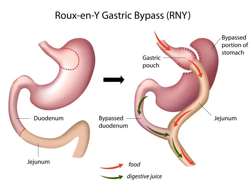 Roux y Gastric Bypass Turkey