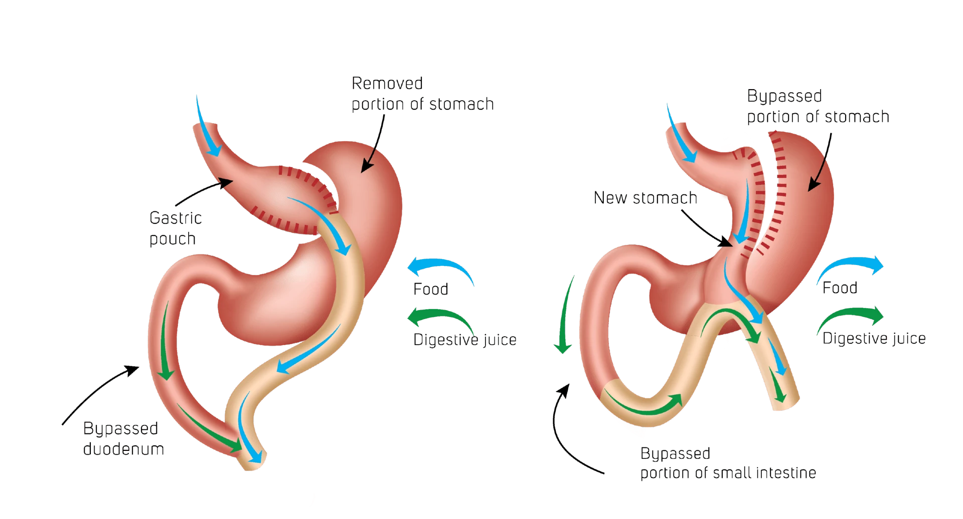 Difference Between mini gastric bypass and roux en y