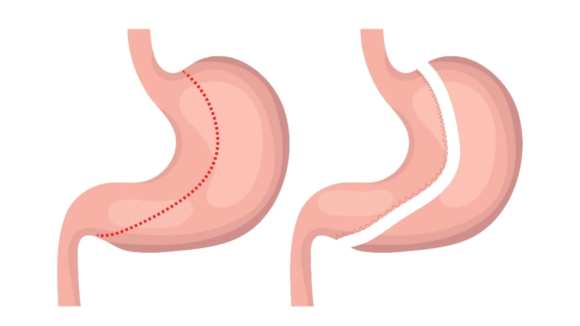 Understanding Sleeve Gastrectomy Surgery: A Path to Weight Loss