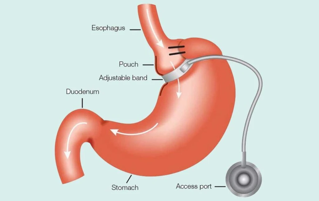 Gastric Band Surgery in Turkey